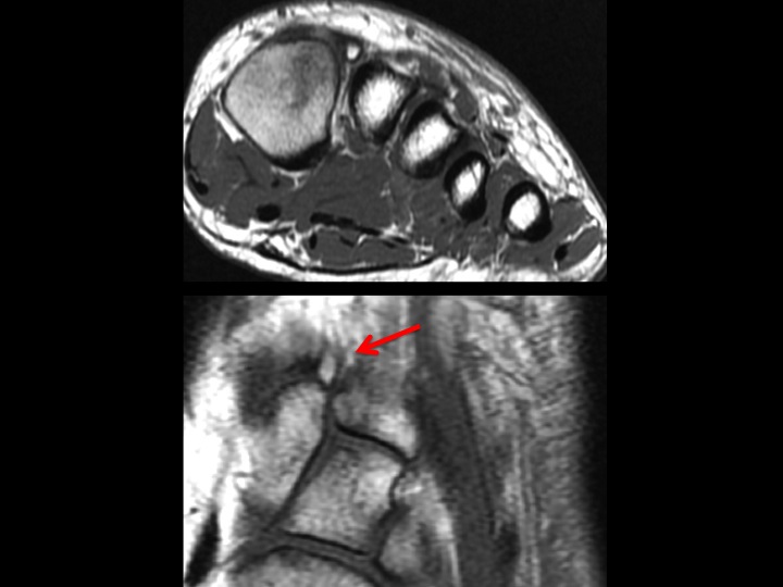 Figure 3 for case os intermetatarseum